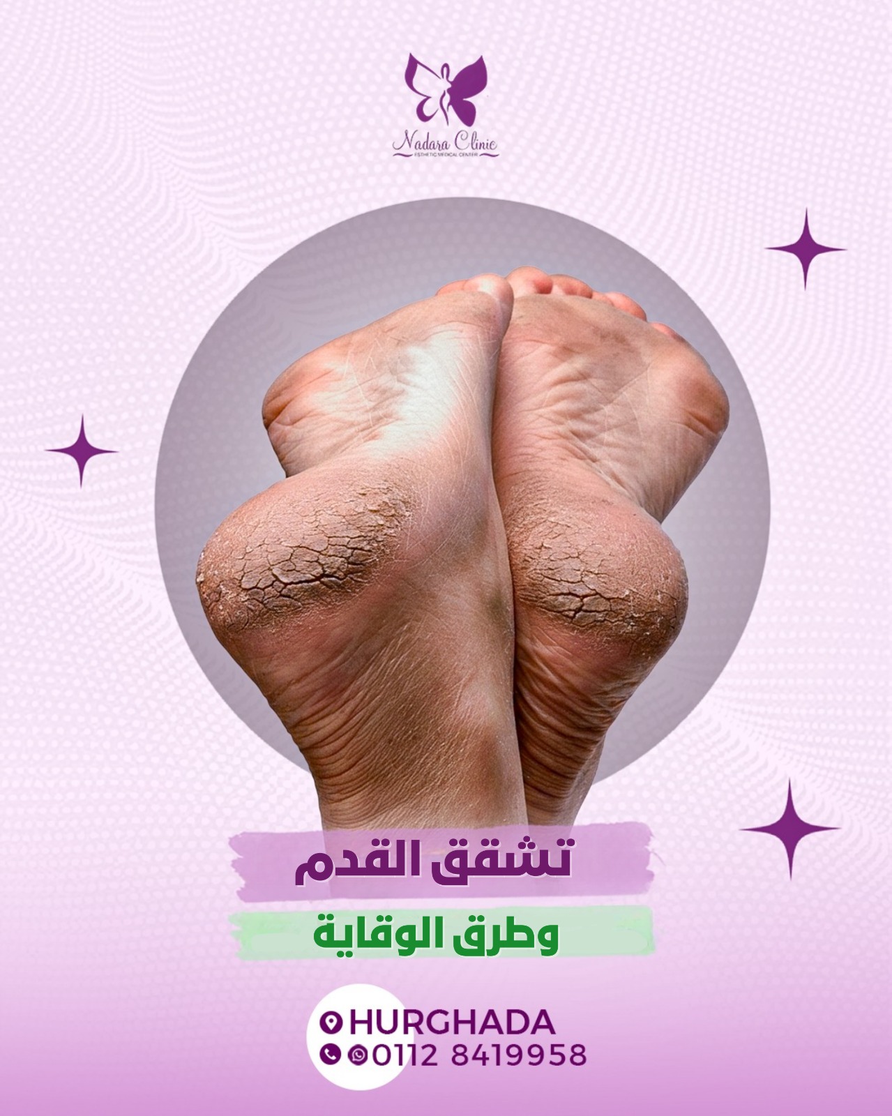 تشققات القدم وطرق الوقاية في الغردقة